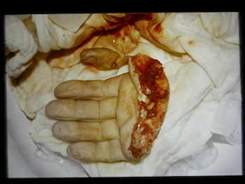 Reimpianto Mano