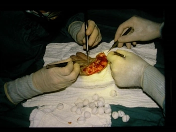Reimpianto Mano