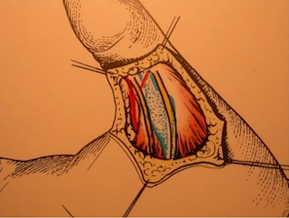 Puleggia 1