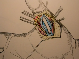Puleggia 2