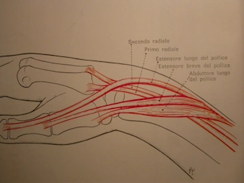 Morbo di de quervain Morbo di de quervain