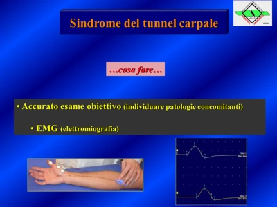 Tunnel Carpale - Fig.5