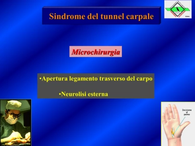 Tunnel Carpale - Fig.7
