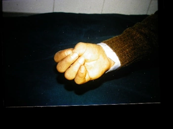 mano amputata